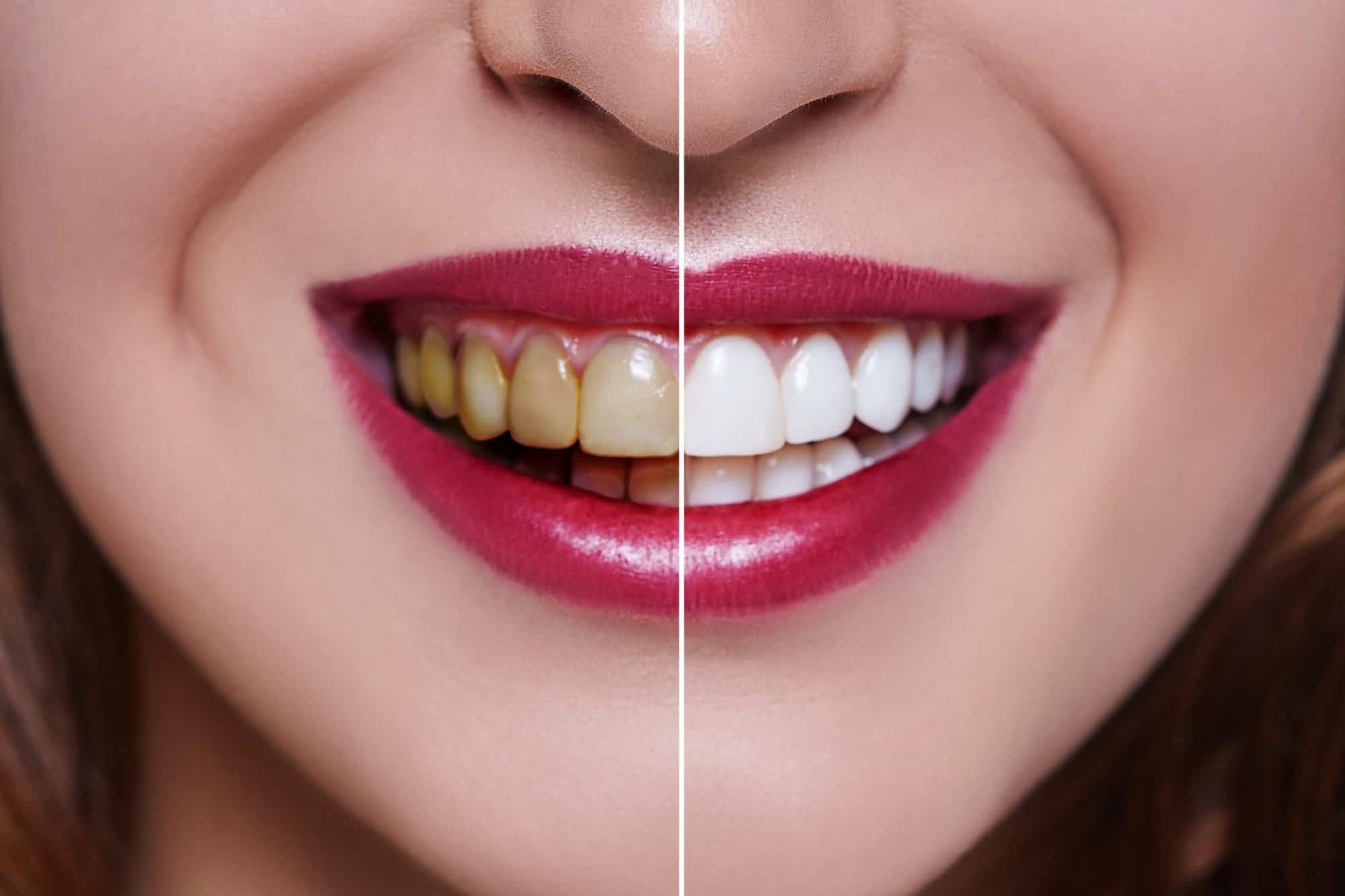 Teeth whitening pic